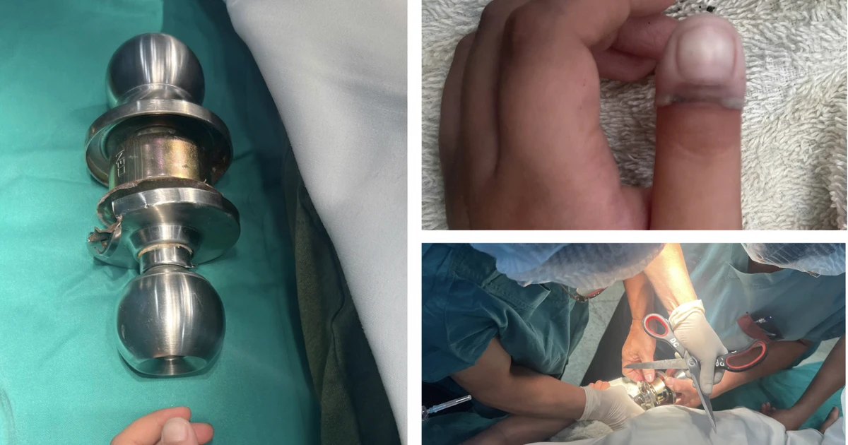 Bé 5 tuổi mắc kẹt ngón tay vào ổ khóa, thoát hiểm ngoạn mục