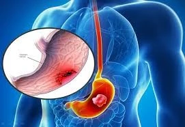 Trẻ 13 tuổi phải phẫu thuật vì thủng ổ loét dạ dày do thói quen sinh hoạt xấu