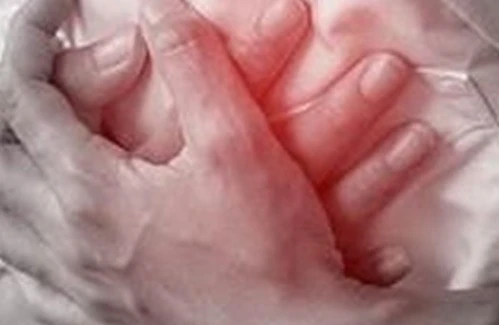 Phẫu thuật thành công cho nam bệnh nhân 44 tuổi bị nhồi máu cơ tim cấp