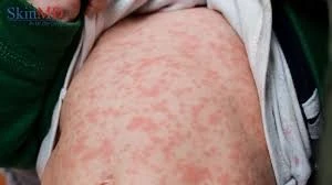 Cảnh báo trẻ nhỏ bị phát ban nguy hiểm dễ nhầm lẫn