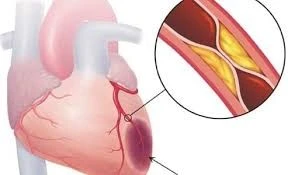Cảnh báo về nhầm lẫn triệu chứng nhồi máu cơ tim và đột quỵ mùa lạnh