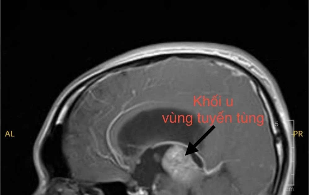 Thanh niên trẻ mắc u vùng tuyến tùng hiếm gặp được điều trị thành công