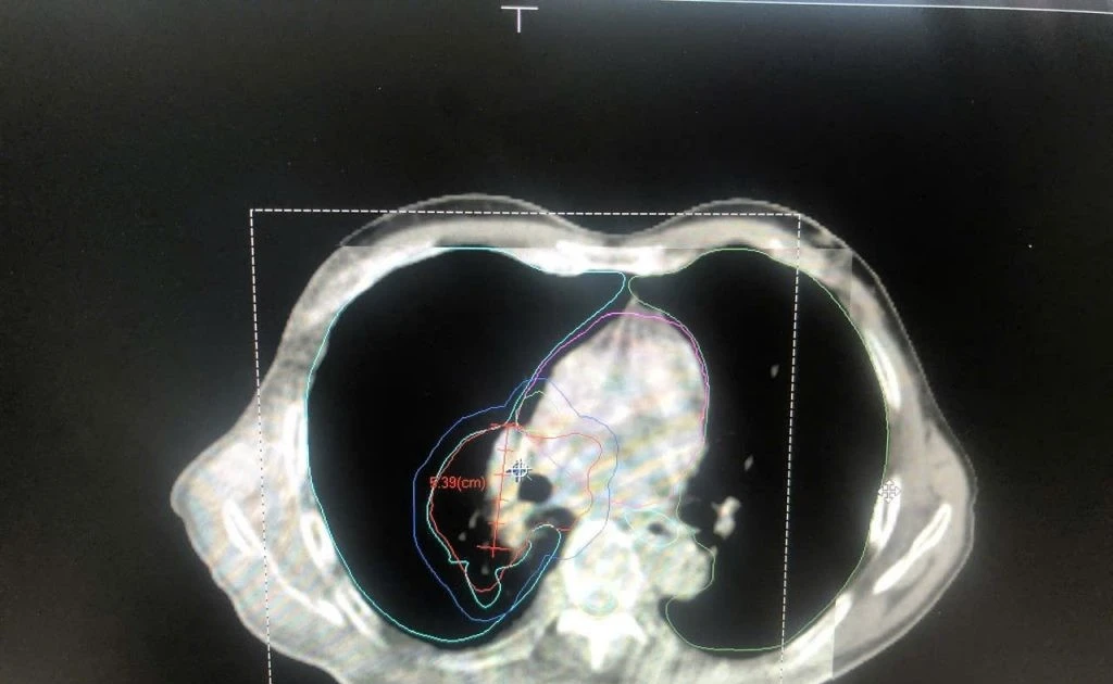 Điều trị ung thư phổi bằng phương pháp kết hợp hoá xạ trị mang lại hy vọng