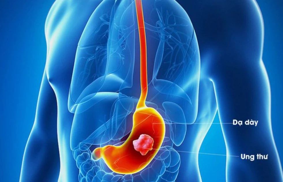 Ca phẫu thuật cho bệnh nhân ung thư dạ dày kết hợp 'sửa' dị tật bẩm sinh