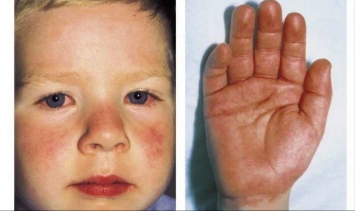 Nhận biết dấu hiệu bệnh Kawasaki