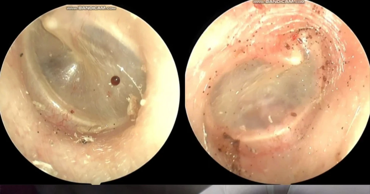 Bác sĩ gắp thành công bọ chó sống trong tai bệnh nhân 60 tuổi