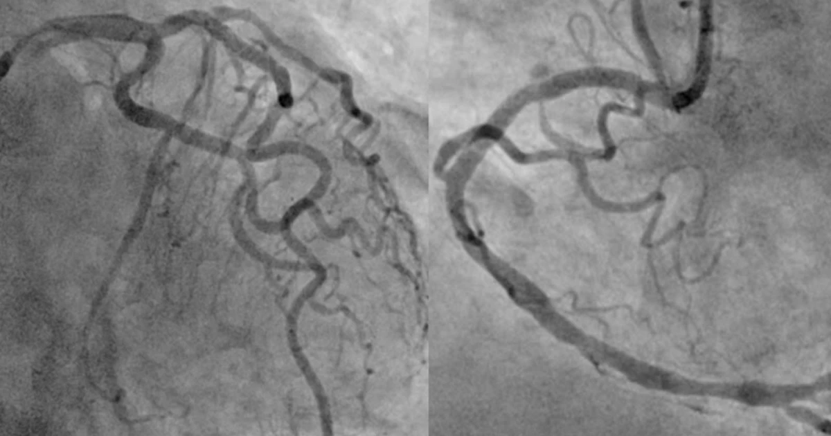 Cứu sống ngoạn mục người bệnh ngưng tim 2 lần do nhồi máu cơ tim cấp