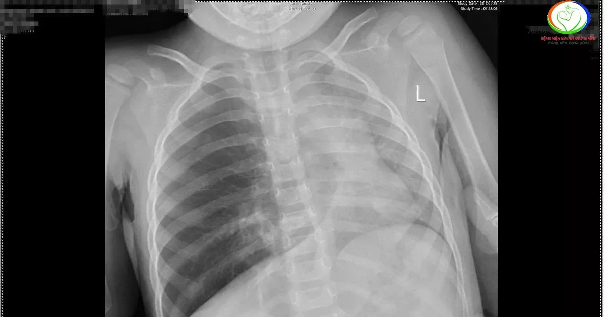 Hai trẻ nhập viện cấp cứu vì hóc dị vật nguy hiểm tại Quảng Ninh