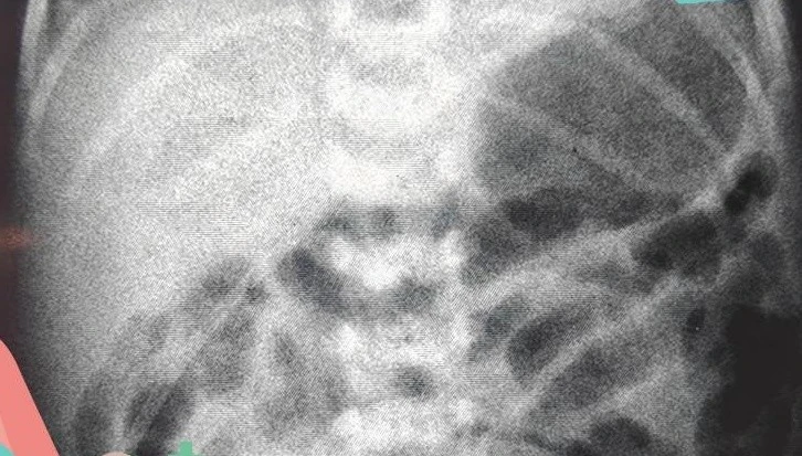 Cứu sống bé trai sinh non mắc teo ruột hiếm gặp tại Cần Thơ