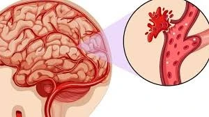 Phát hiện kịp thời huyết khối tĩnh mạch não giúp người bệnh hồi phục nhanh