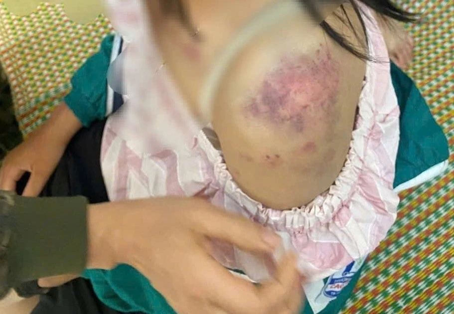 Bé gái 13 tuổi bị bạo hành ở Thái Nguyên, tình hình sức khỏe thế nào?