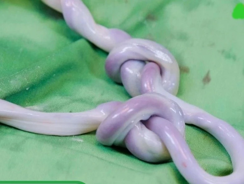 Bé trai chào đời khỏe mạnh sau ca sinh hiếm gặp dây rốn bị thắt hai nút