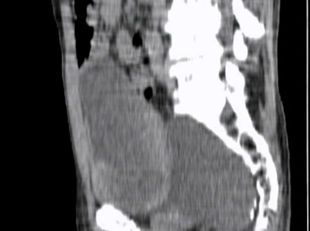 Phẫu thuật nội soi giúp bệnh nhân lớn tuổi thoát khỏi tiểu khó