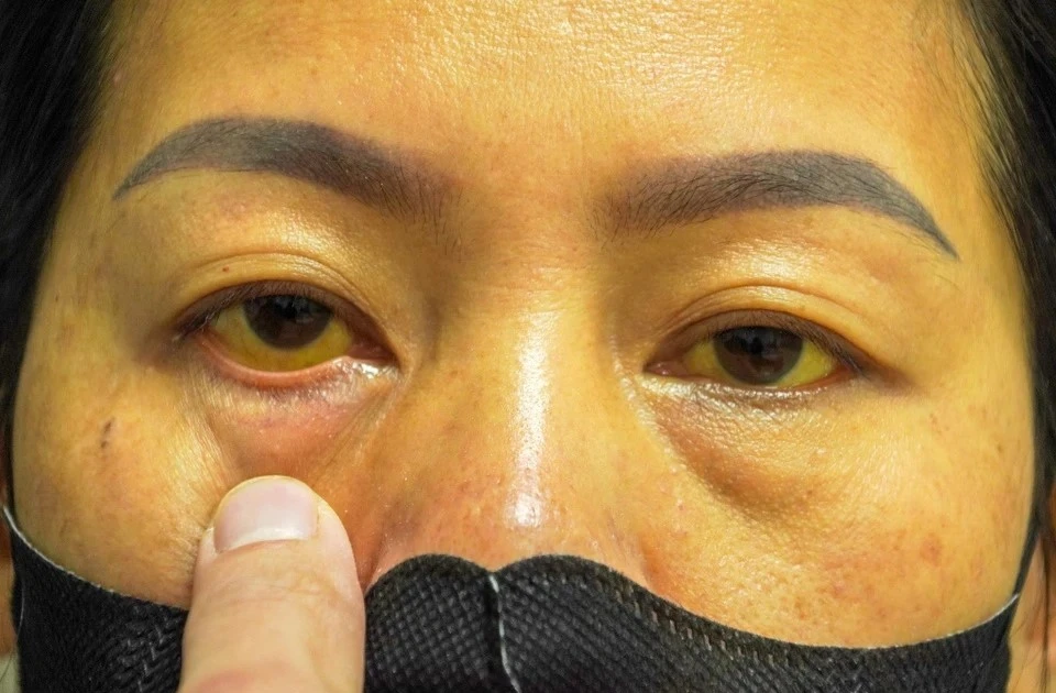 Người phụ nữ bị suy gan nguy hiểm do tự ý dùng thuốc nam chữa đau đầu