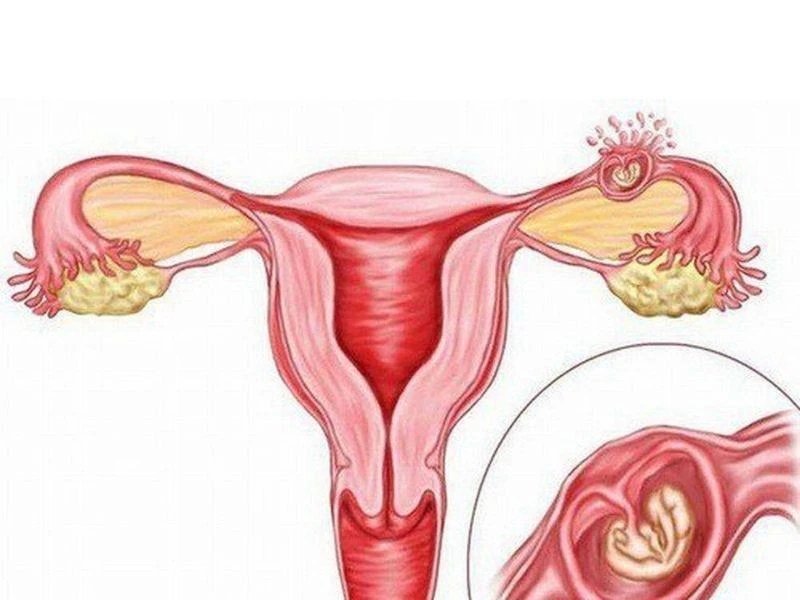 Phẫu thuật cứu sản phụ bị chửa ngoài tử cung vỡ đe dọa tính mạng