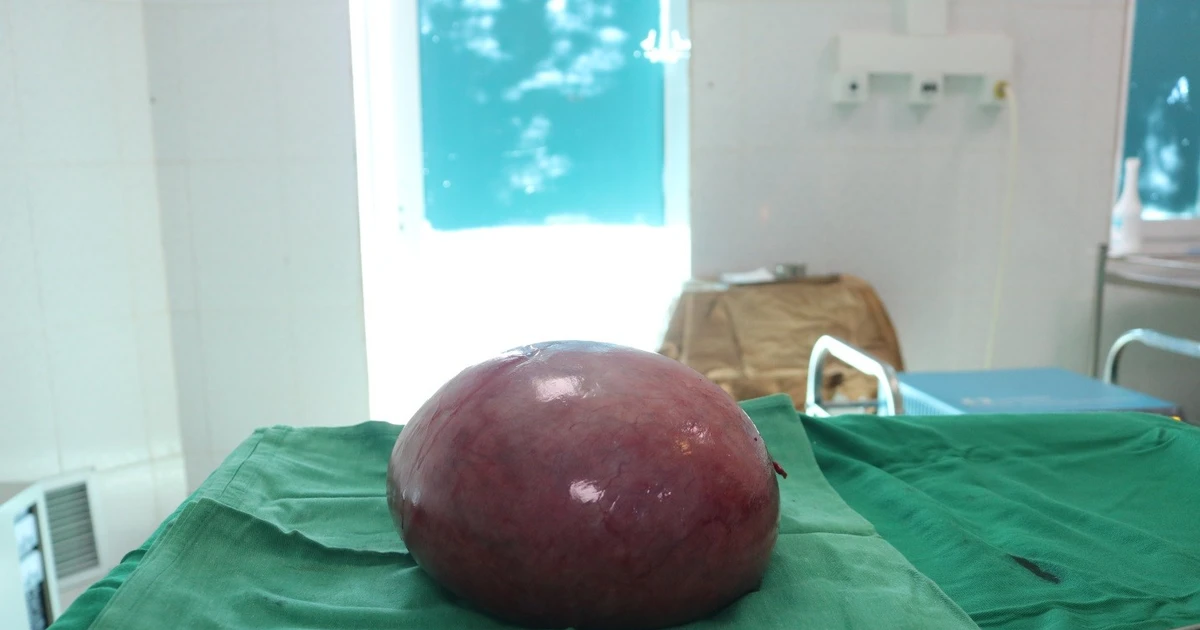 Người phụ nữ ở Lai Châu thoát khỏi khối u xơ tử cung lớn sau ca mổ thành công