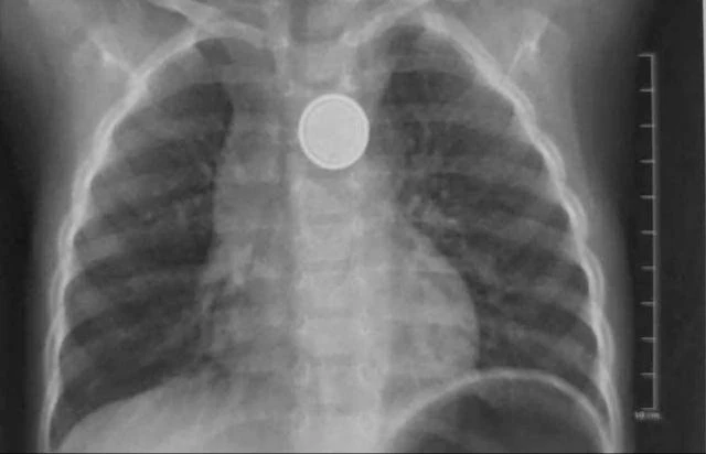 Bé trai gần 3 tuổi loét thực quản vì nuốt phải pin cúc áo