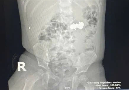 Trẻ nhỏ nuốt 4 viên đinh nam châm nguy hiểm, được cứu kịp thời tại Nghệ An