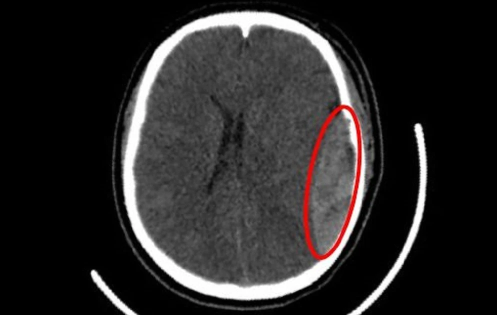Phẫu thuật cứu sống nữ sinh chấn thương sọ não do tà áo dài quấn vào bánh xe