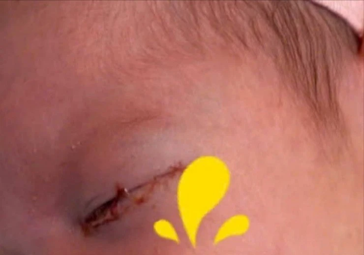 Chẩn đoán sớm viêm kết mạc sơ sinh giúp giảm nguy cơ biến chứng nặng