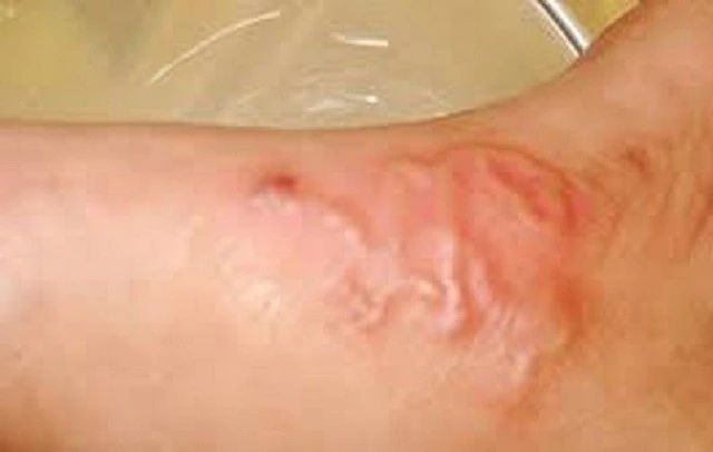 Gần 6.400 người mắc bệnh giun sán trong 3 tháng ở Khánh Hòa