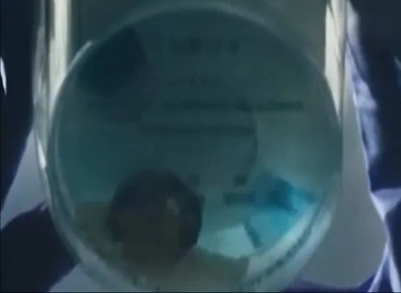 Phát minh giúp phát hiện sớm bệnh thận qua nước bồn cầu đổi màu