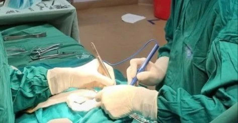 Điều trị thành công trẻ sơ sinh viêm phúc mạc do thủng ruột