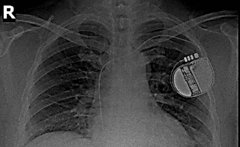 Thiết bị phá rung tim, cứu sống người bệnh mắc hội chứng tái cực sớm