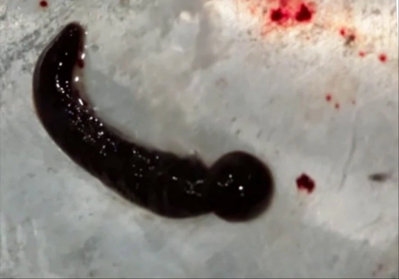 Con đỉa dài 6 cm sống trong mũi người phụ nữ suốt 3 tuần