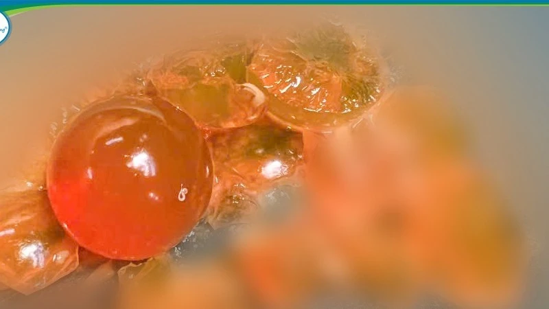 Nuốt hạt nhựa nở, bé 14 tháng thoát khỏi cắt ruột nhờ phẫu thuật kịp thời