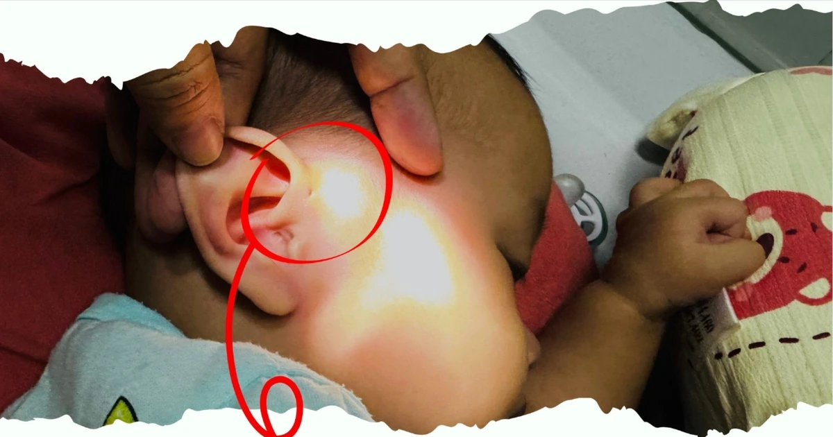 Bé 6 tháng tuổi bị áp xe thái dương vì rò luân nhĩ