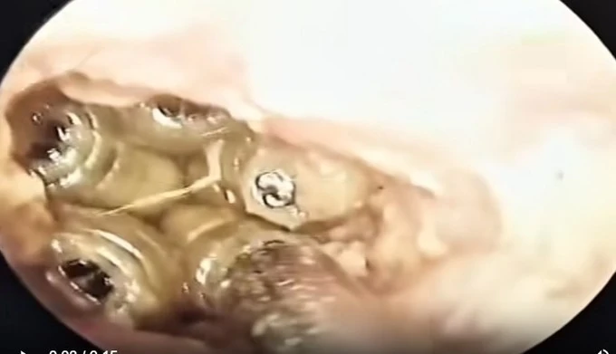 Gắp 5 con giòi sống trong tai một nữ bệnh nhân