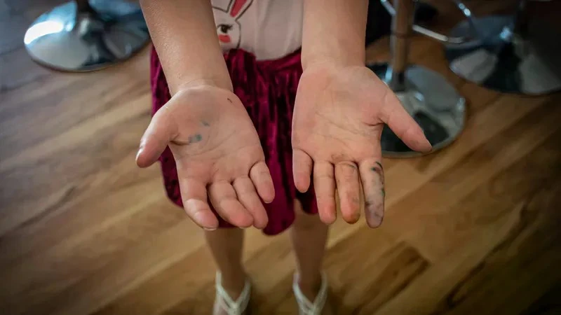 Nhiễm giun sán gây ảnh hưởng gì đối với sức khỏe?