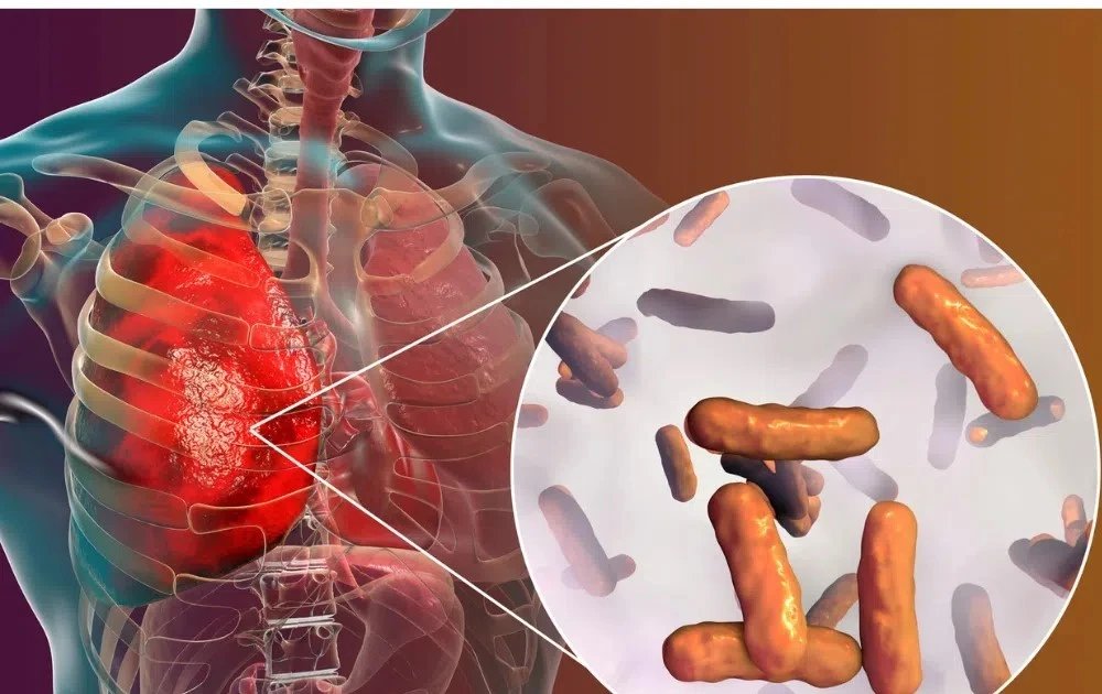 Phát hiện một hợp chất đột phá mang tên CMX410 có thể điều trị bệnh lao