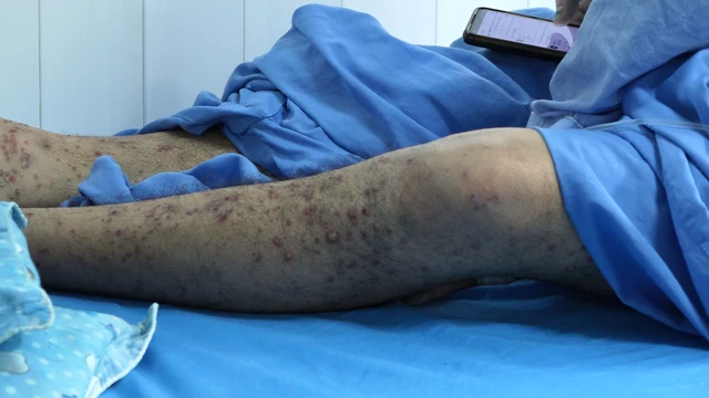 Bệnh nhân thủy đậu biến chứng nặng, thoát chết trong gang tấc