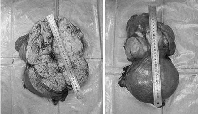 Khối u lớn chiếm gần trọn ổ bụng dưới, khiến người phụ nữ nhầm mang song thai