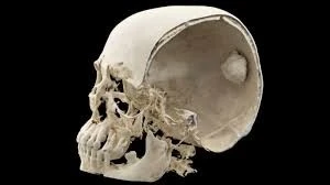 Người phụ nữ có khối u nền sọ khổng lồ tại “vị trí cấm kỵ”