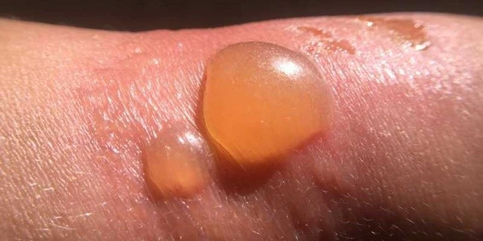 Nồi hấp bánh bao văng trúng khiến bé trai 7 tuổi bị bỏng nặng