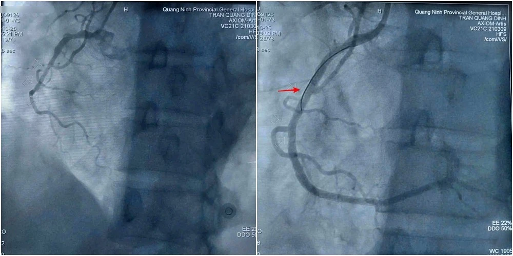 Can thiệp đặt stent, cứu bệnh nhân nhồi máu cơ tim sau phẫu thuật nội soi