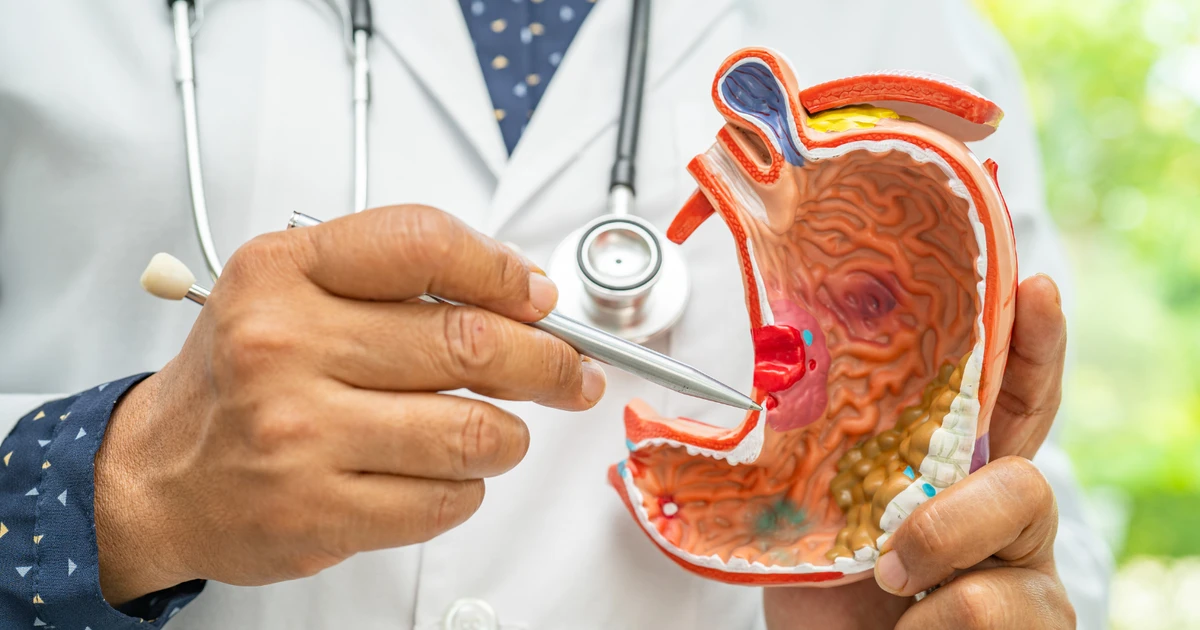 Phát hiện ung thư dạ dày di căn sau khi đi khám đầy bụng khó tiêu