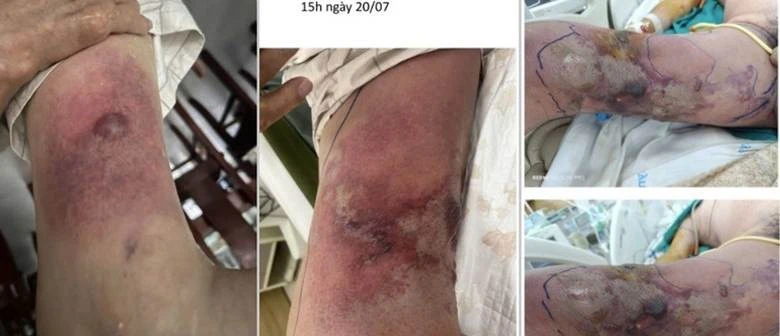 Vi khuẩn Vibrio vulnificus đe dọa tính mạng qua vết thương hở