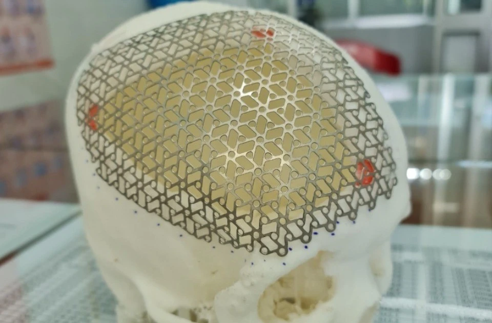 Kỹ thuật vá sọ 3D Titanium giúp bệnh nhân khuyết sọ hồi phục toàn diện