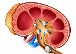 Bệnh nhân bị sỏi thận nặng được điều trị thành công bằng kỹ thuật Mini PCNL