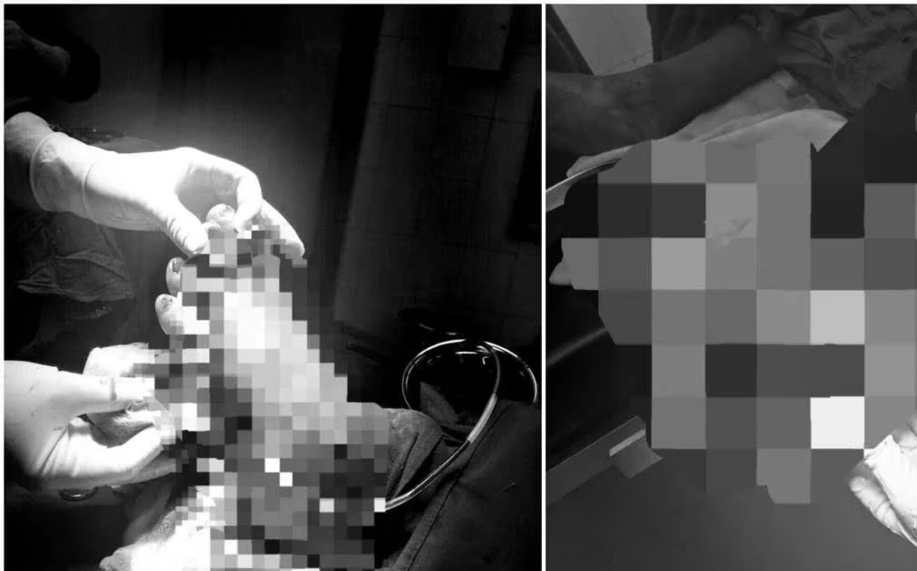 Bệnh nhân ở Quảng Trị hồi phục sau ca nối bàn chân đứt rời