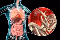 Ký sinh trùng dài 7 mét trong cơ thể người 