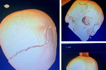 2 lần mổ não cứu trẻ 14 tuổi bị tai nạn vỡ toạc sọ