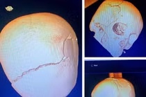2 lần mổ não cứu trẻ 14 tuổi bị tai nạn vỡ toạc sọ