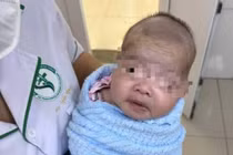 Mới sinh 8 ngày trẻ đã bị uốn ván nguy kịch