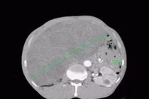 Đang khỏe mạnh, 3 tháng u đã phát triển chiếm hết ổ bụng, nặng 5kg