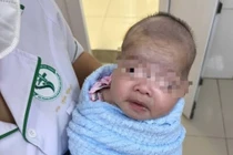 Mới sinh 8 ngày trẻ đã bị uốn ván nguy kịch